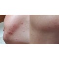 ژل ضد جوش و لایه بردار آداپالن ۰.۱ درصد مناسب پوست مستعد آکنه دیفرین دیفرین | Differin Adapalene Gel 0.1 حجم 30 گرم