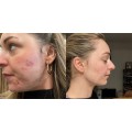 ژل ضد جوش و لایه بردار آداپالن ۰.۱ درصد مناسب پوست مستعد آکنه دیفرین دیفرین | Differin Adapalene Gel 0.1 حجم 30 گرم