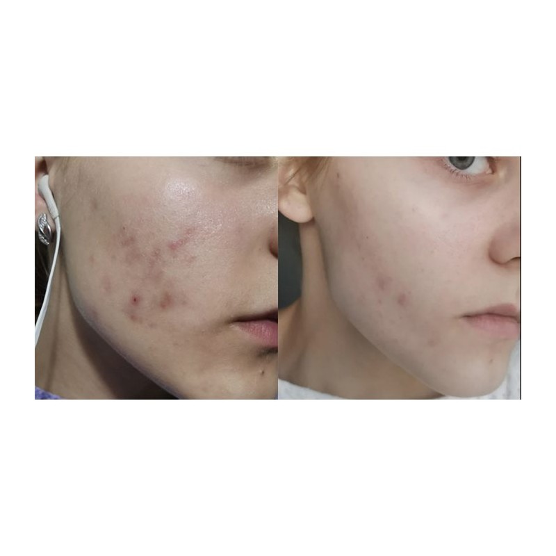 ژل ضد جوش و لایه بردار آداپالن ۰.۱ درصد مناسب پوست مستعد آکنه دیفرین دیفرین | Differin Adapalene Gel 0.1 حجم 30 گرم