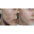 ژل ضد جوش و لایه بردار آداپالن ۰.۱ درصد مناسب پوست مستعد آکنه دیفرین دیفرین | Differin Adapalene Gel 0.1 حجم 30 گرم