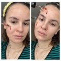 سرم لایه بردار قوی پیلینگ و ضد جوش مناسب انواع پوست اسکین ۱۰۰۴ اسکین ۱۰۰۴ | SKIN1004 Zombie Beauty Bloody Peel حجم 30 میل
