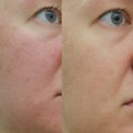 سرم لایه بردار قوی پیلینگ و ضد جوش مناسب انواع پوست اسکین ۱۰۰۴ اسکین ۱۰۰۴ | SKIN1004 Zombie Beauty Bloody Peel حجم 30 میل