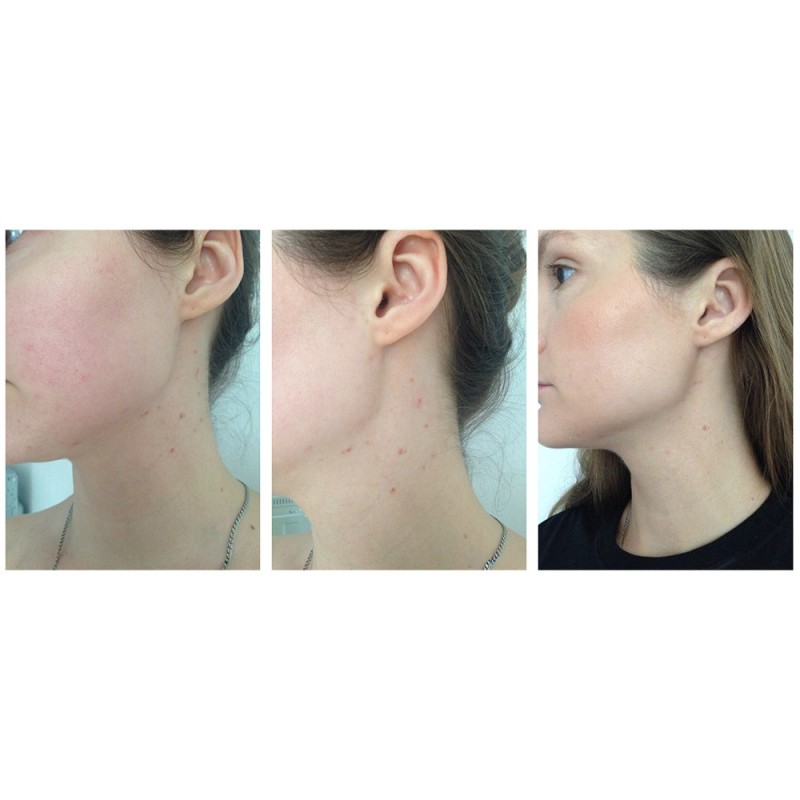 تونر لایه بردار درمانی آبرسان و شفاف کننده AHA-BHA کوزارکس COSRX AHA-BHA Clarifying Treatment Toner 150ml